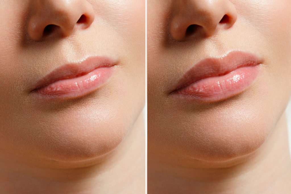 A woman makes lip shape correction in a cosmetology clinic. Lips injections, lip augmentation