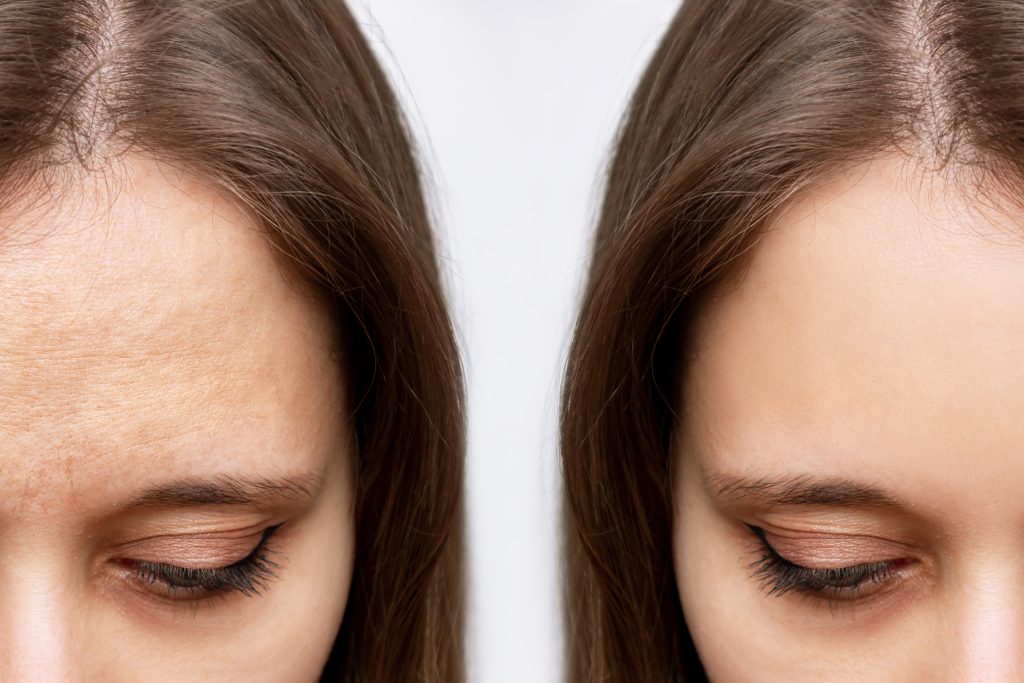 Close up of somebody's face before and after skin