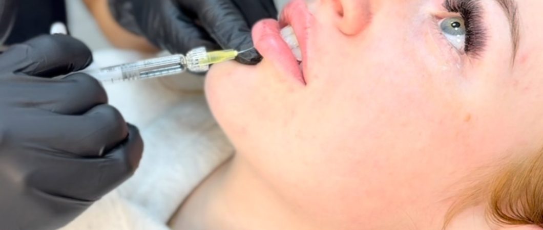 Behandeling-lip-fillers-8