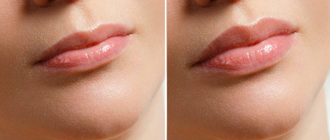 lippen opvullen amsterdam